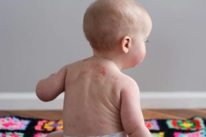 eczema treatment before and after